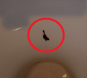 260205 おしっこでなにか出てきた！腫瘍のかけら？